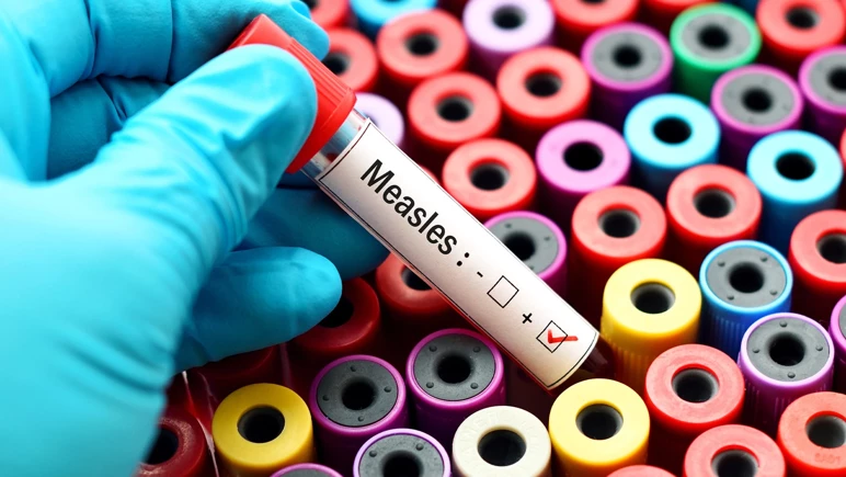 Çocukluk hastalığı geri döndü!